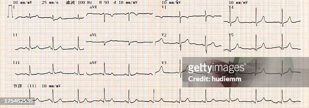 cardiogram chart (ecg) - electrocardiograms stock pictures, royalty-free photos & images