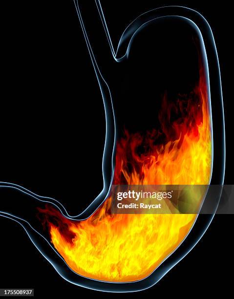sodbrennen/magenverstimmung - säure stock-fotos und bilder