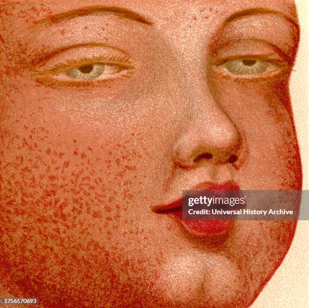 Scarlatina or Scarlet Fever. From The Household Physician, published c.1898.