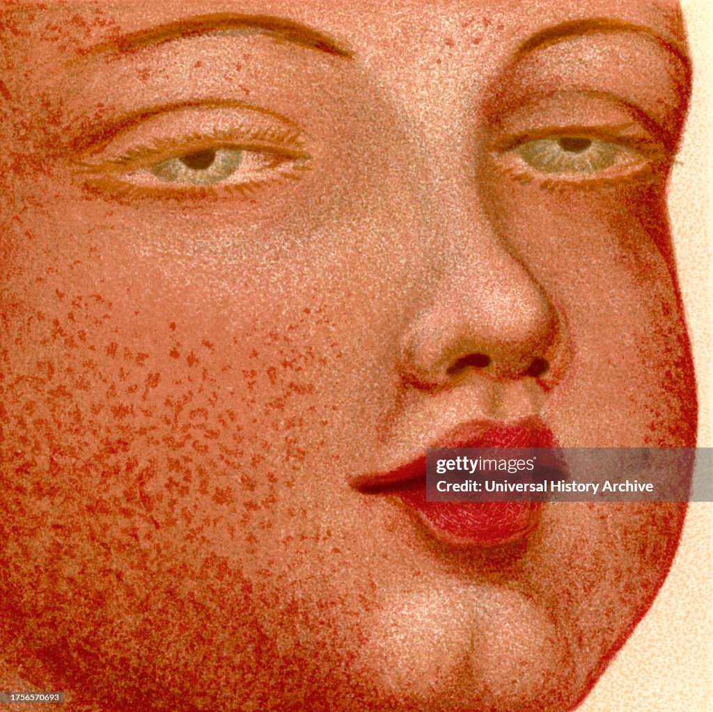 Eruptive Fevers: Scarlatina or Scarlet Fever