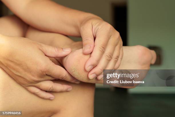 dry and cracked soles of feet on green background - piede umano foto e immagini stock