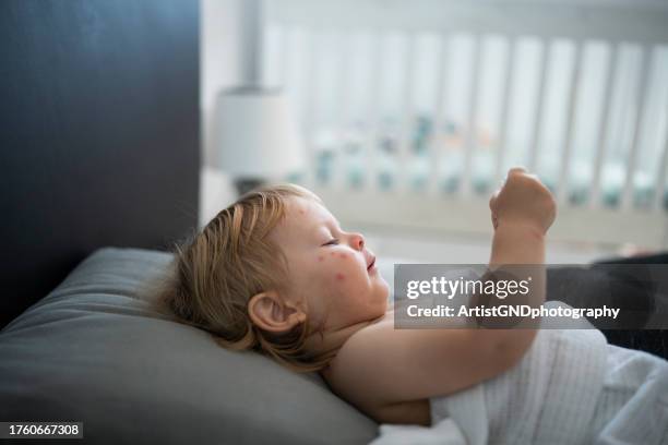 bebé con varicela acostado en la cama. - varicela fotografías e imágenes de stock