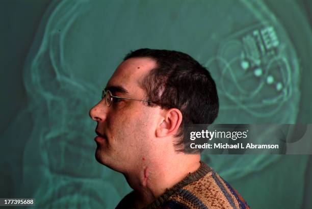 Reed Kohn, an epileptic who received a brain implant, poses in front of a large brain scan, December 16, 2004.