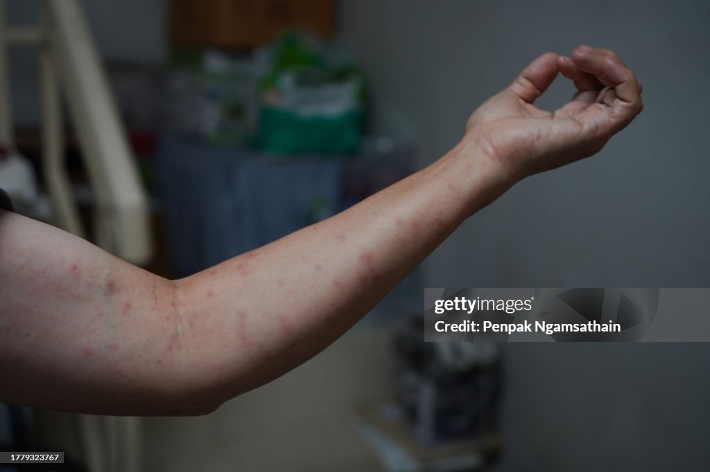 Red Swollen Rash On The Arm High-Res Stock Photo - Getty Images