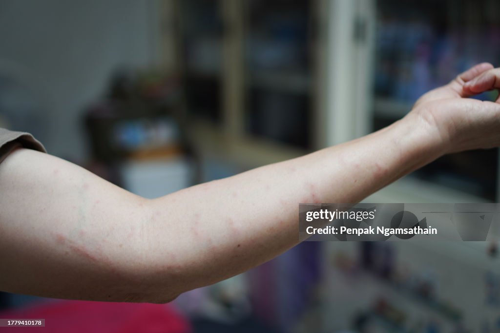 Red, swollen rash on the arm