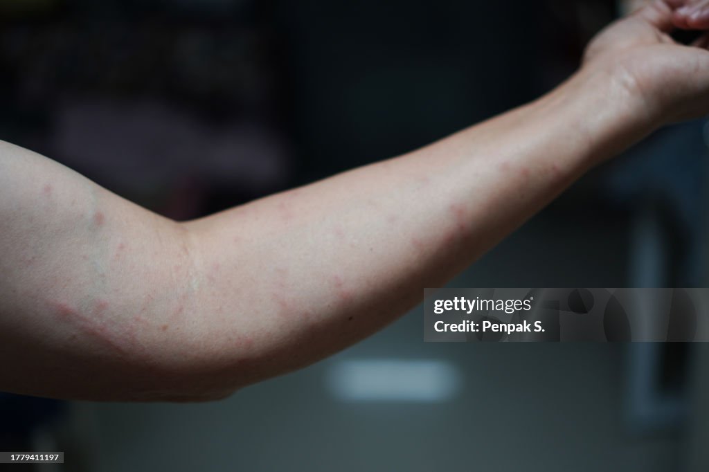 Arm Put Rash Red Swollen Rash On The Arm High-Res Stock Photo - Getty Images