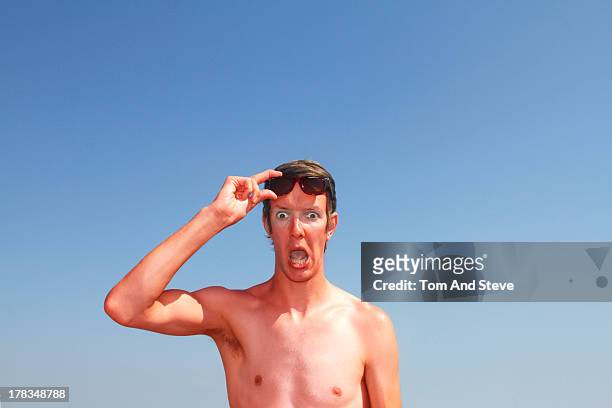 an angry man with sunburn looks shocked - rash stock pictures, royalty-free photos & images
