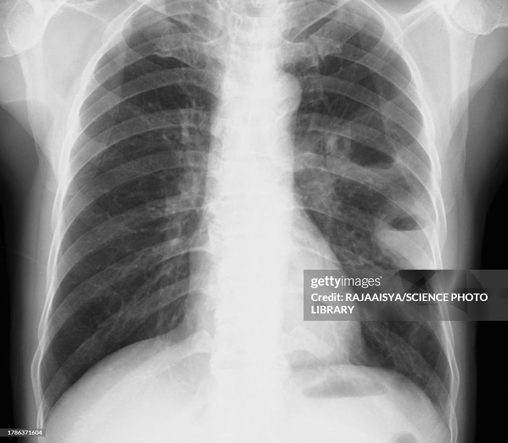 Calcified Abscess Lung Abscesses Xray High-Res Stock Photo - Getty Images