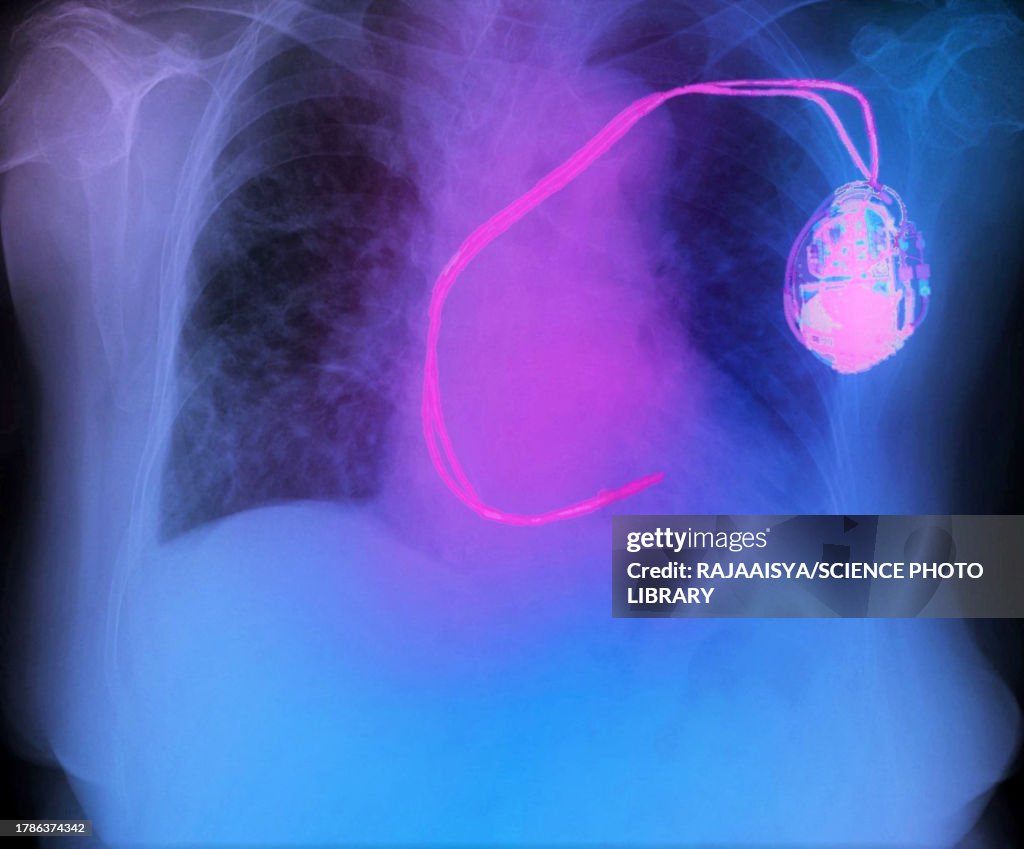 Gi Pacemaker Pacemaker Xray High-Res Stock Photo - Getty Images