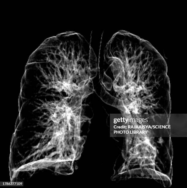 healthy lungs, ct scan - bronchus stock pictures, royalty-free photos & images