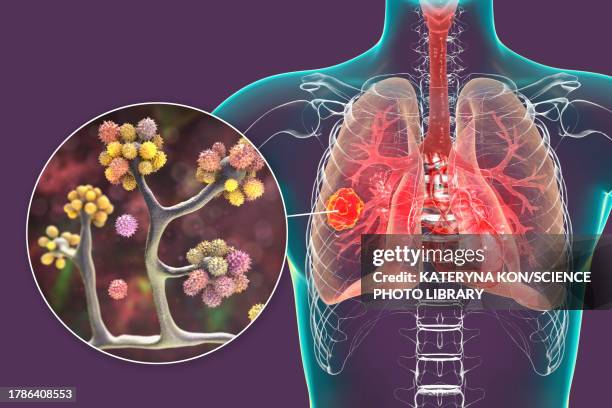 lung mucormycosis lesion, illustration - respiratory infection stock illustrations