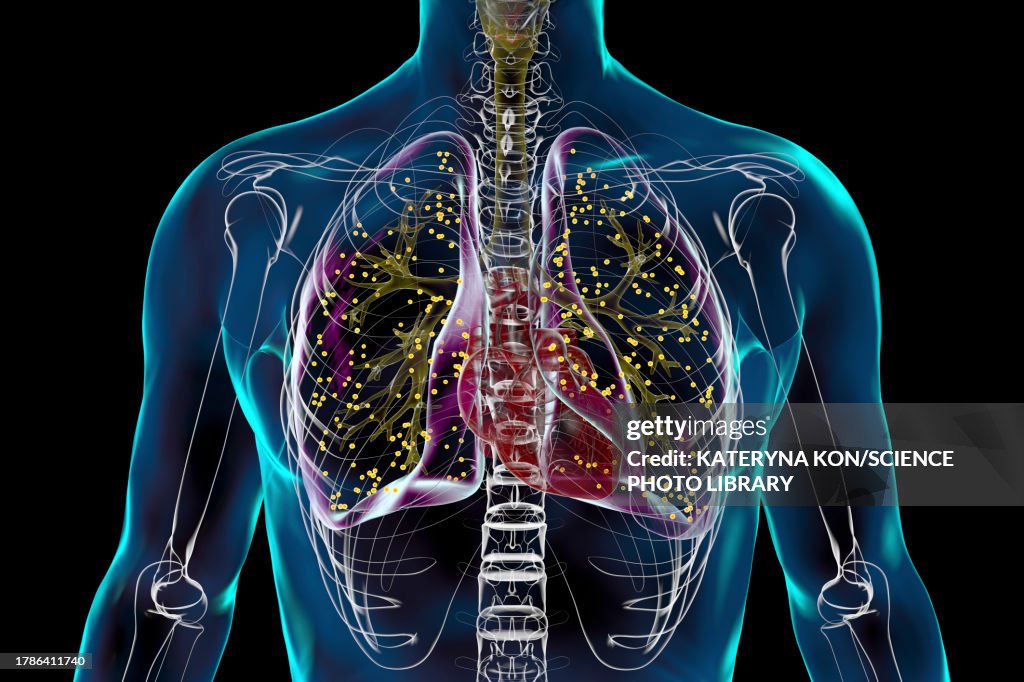 Lungs affected by miliary tuberculosis, illustration
