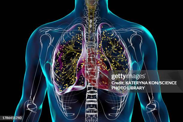 lungs affected by miliary tuberculosis, illustration - tuberculosis bacterium stock illustrations