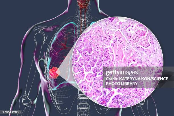 lung cancer tumour and light micrograph, illustration - 光学顕微鏡図点のイラスト素材／クリップアート素材／マンガ素材／アイコン素材