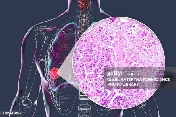 ilustrações de stock, clip art, desenhos animados e ícones de lung cancer tumour and light micrograph, illustration - epitélio escamoso