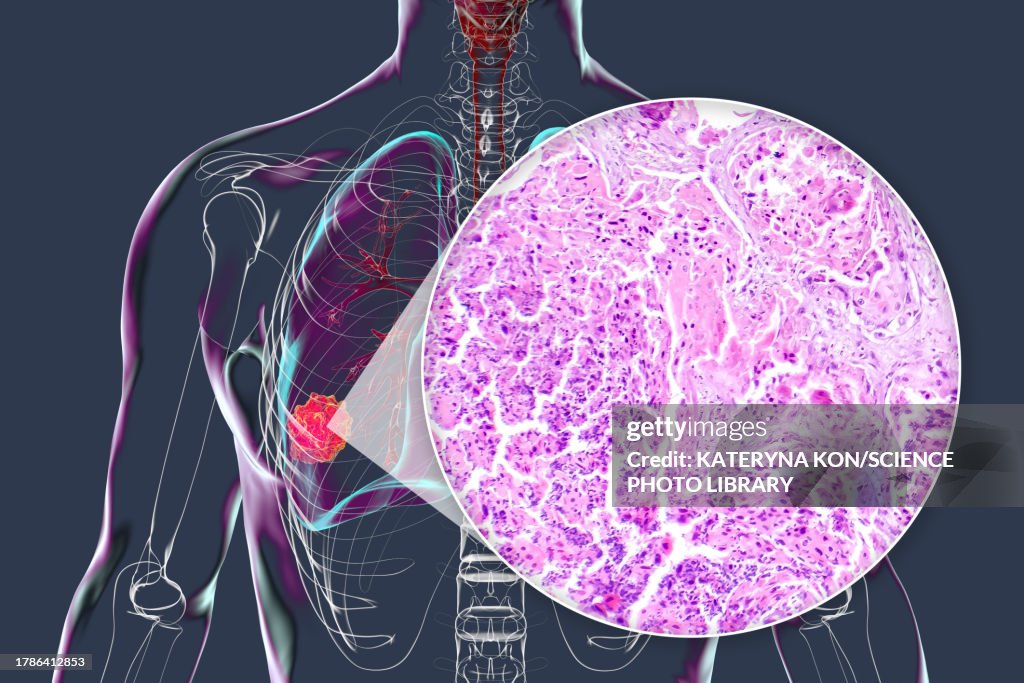 Lung cancer tumour and light micrograph, illustration