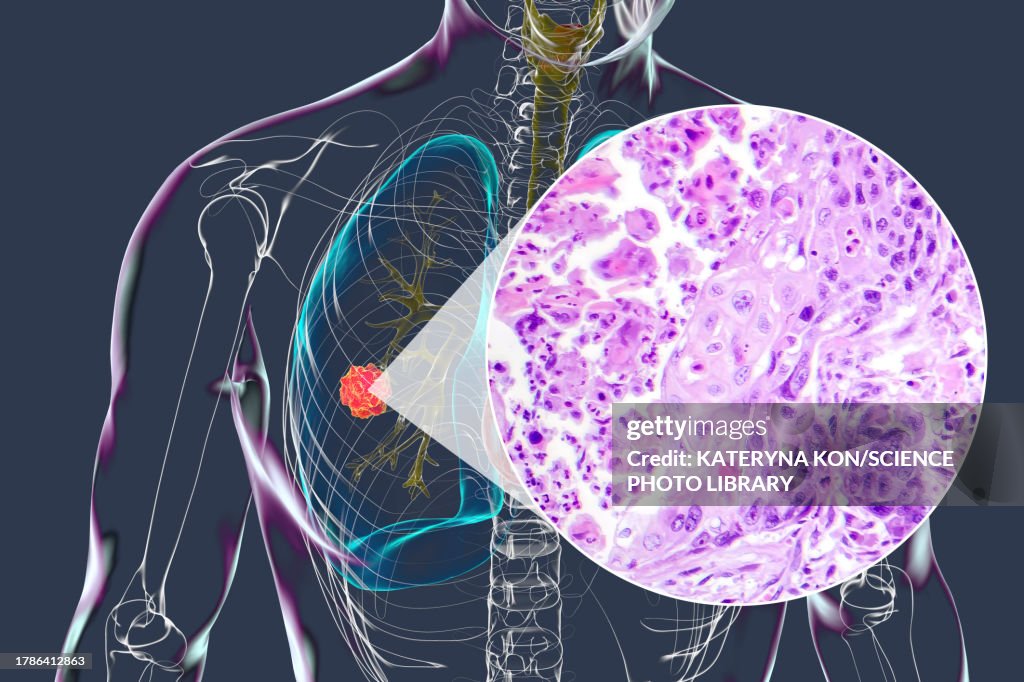 Lung cancer tumour and light micrograph, illustration