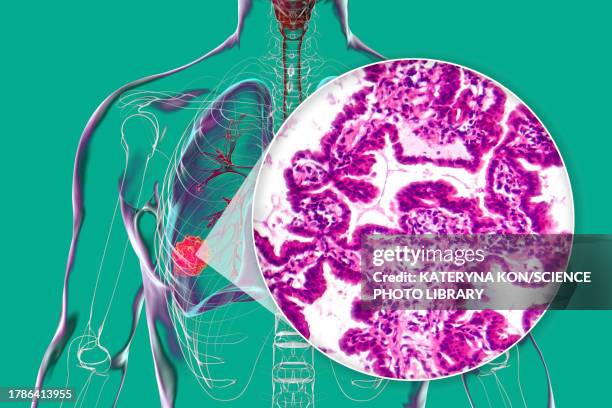 lung cancer tumour and light micrograph, illustration - histology stock illustrations