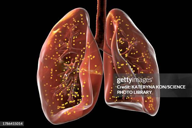 lungs affected by miliary tuberculosis, illustration - tuberculosis bacteria stock illustrations
