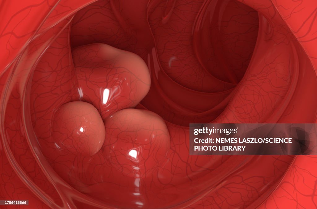 Colon cancer, illustration