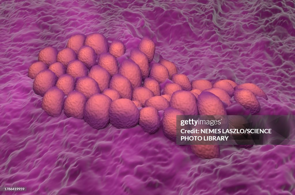 Endometrial cancer, illustration
