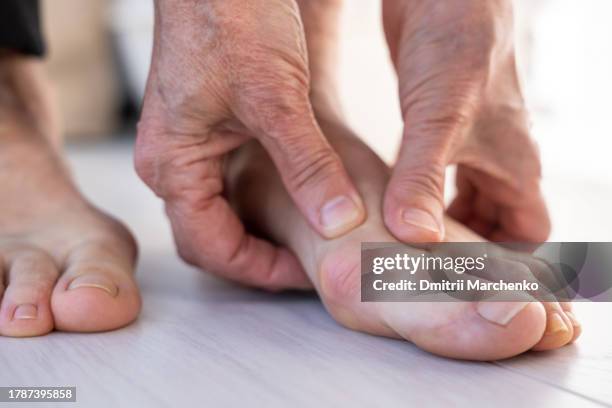 hallux valgus. woman hands kneading bone on foot that protruding, aching and sore at base of big toe - hallux valgus stock pictures, royalty-free photos & images