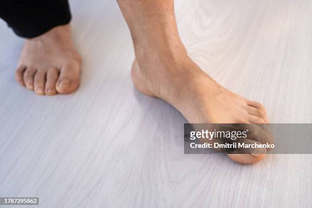feet of adult woman suffering from hallux valgus, uses silicone orthopedic pad between toes - hallux valgus stock pictures, royalty-free photos & images