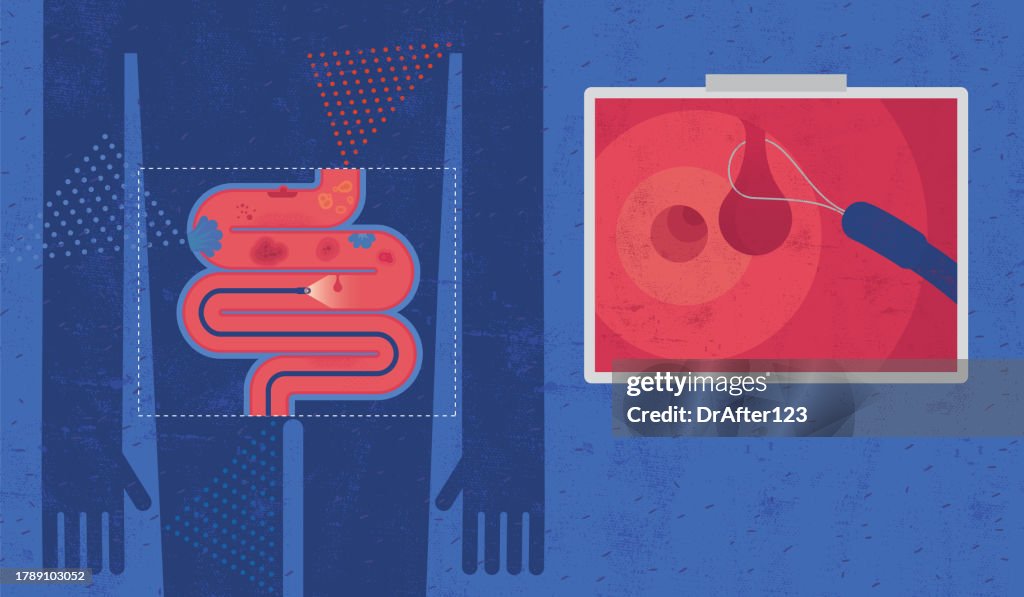 Coloscope Compon Colonoscopy Detecting Colon Abnormalities And Removing Polyp High-Res ...