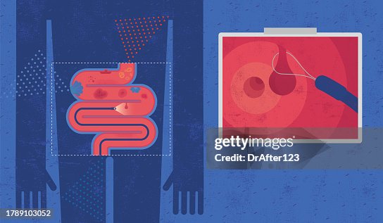 Looping Colon Colonoscopy Detecting Colon Abnormalities And Removing Polyp High-Res ...