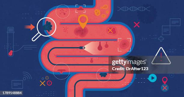 colonoscopy screening test - ulcerative colitis stock illustrations