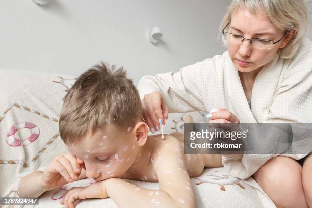 chickenpox in a child - mother applying antiseptic to smallpox pimples on her son's skin - eczema child stock-fotos und bilder