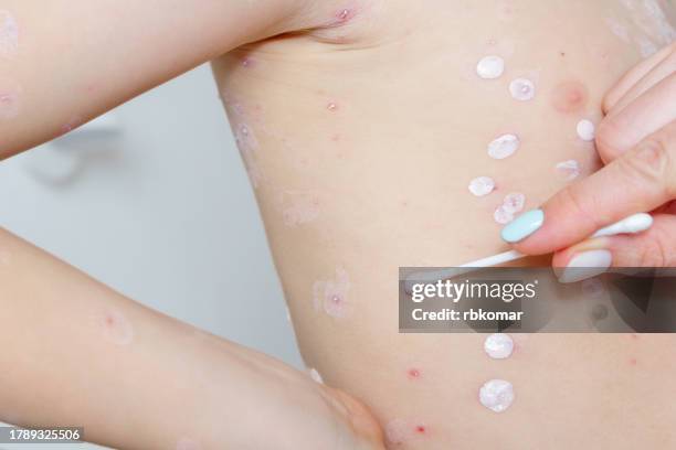 chickenpox treatment - applying moisturizer to skin with pox in a child - varicella zoster virus stock pictures, royalty-free photos & images