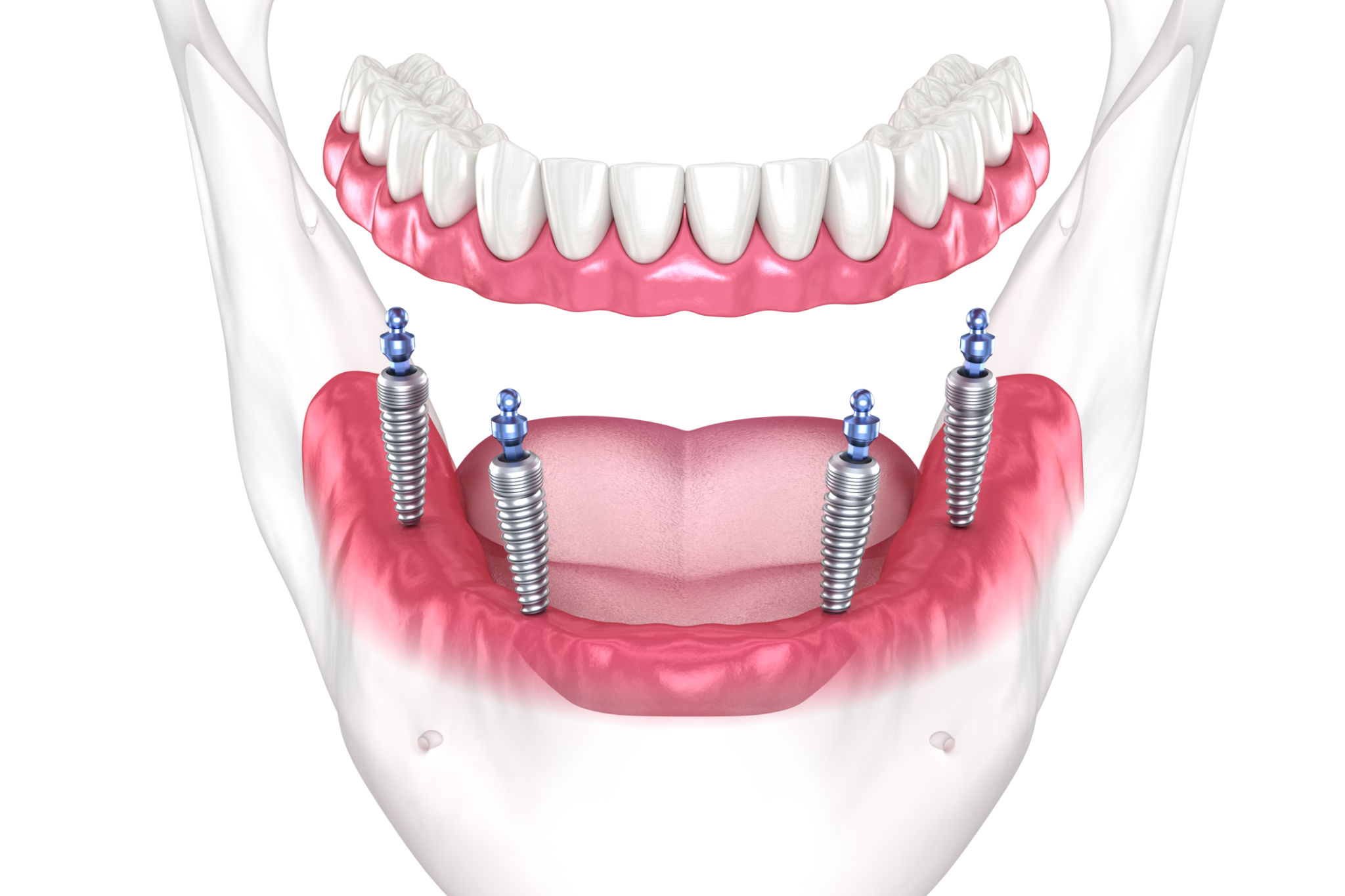 Prótesis removible mandibular Sistema All on 4 soportado por implantes con aditamentos de bola. Ilustración dental en 3D médicamente precisa Prótesis removible mandibular Sistema All on 4 soportado por implantes con aditamentos de bola. Ilustración dental en 3D médicamente precisa