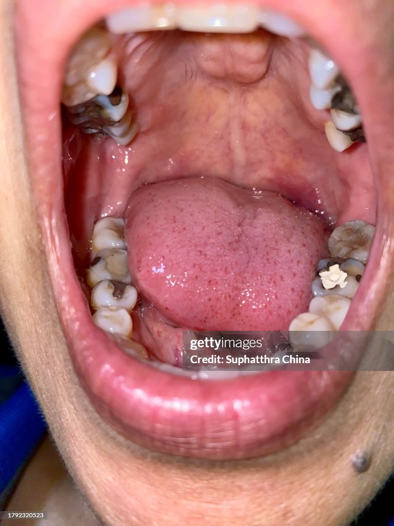 Close up of opened mouth and teeth