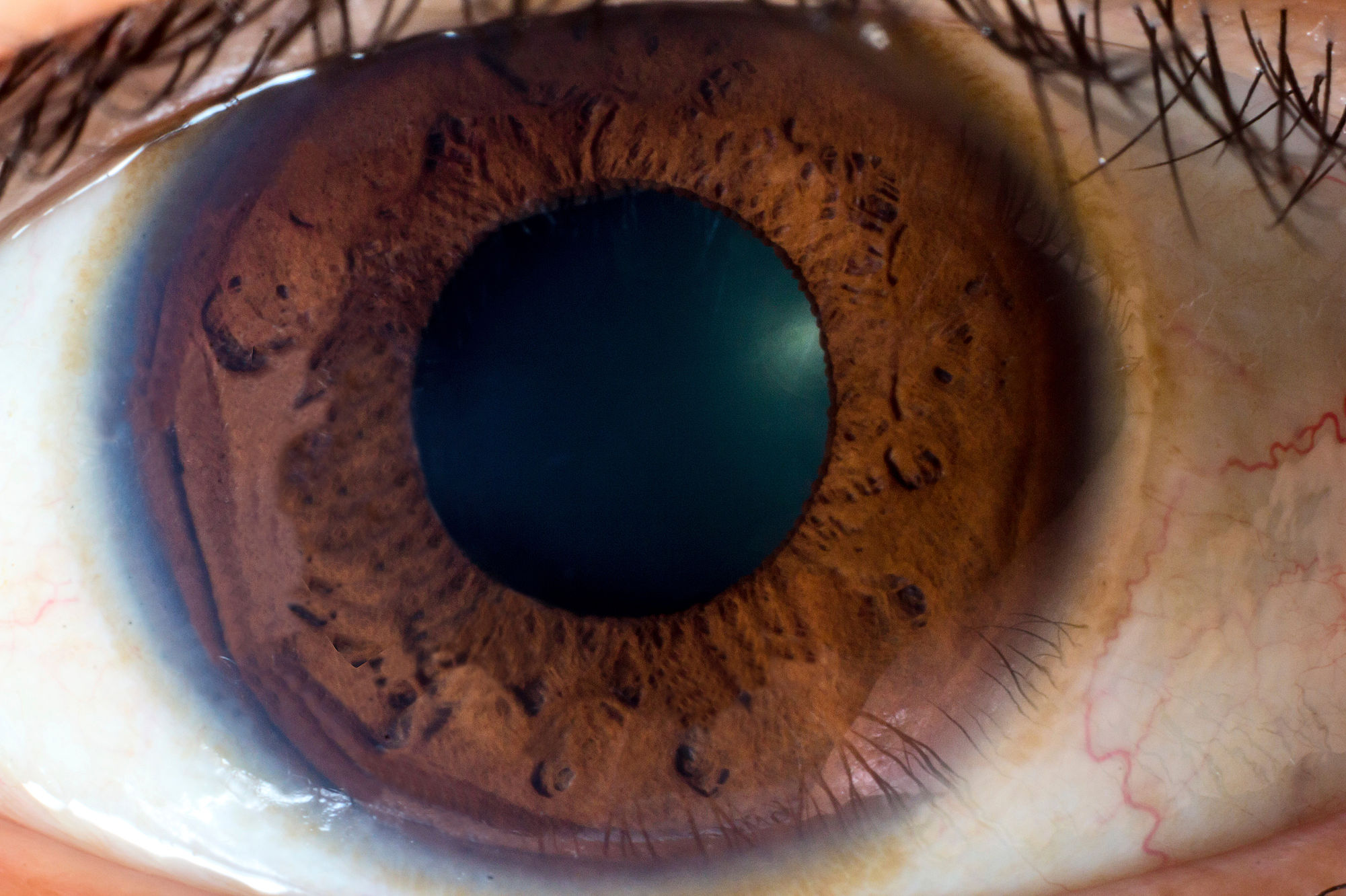 eye iridology