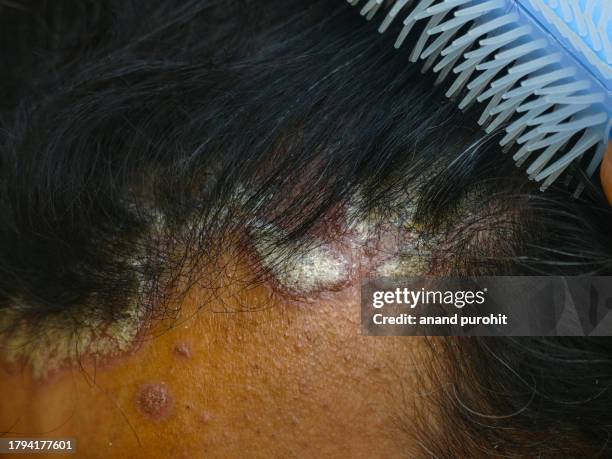 seborrheic dermatitis or scalp psoriasis - seborrheic dermatitis stock pictures, royalty-free photos & images