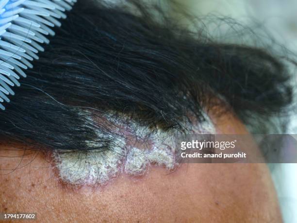 seborrheic dermatitis or scalp psoriasis - seborrheic dermatitis stock pictures, royalty-free photos & images