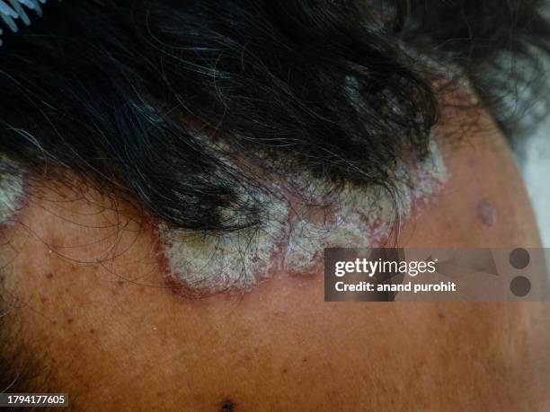 seborrheic dermatitis or scalp psoriasis - seborrheic dermatitis stock pictures, royalty-free photos & images