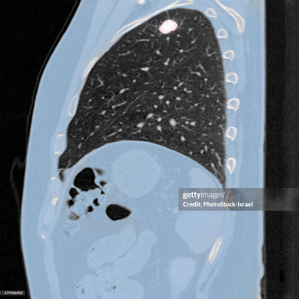 Chest CT scan (X-ray computed tomography) of a male 54 year old patient. A tumour can be seen in the left upper lobe of his lungs
