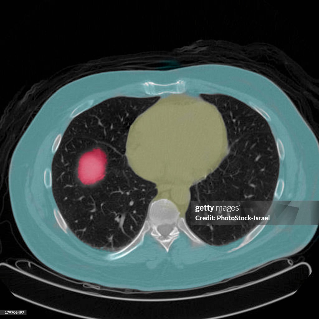 Positron emission tomography (PET) scan of a male, 54 year old patient. A tumour can be seen in the left upper lobe of his lungs