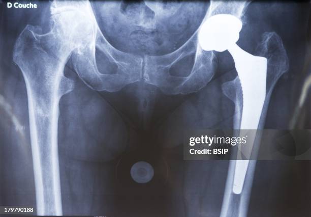 Hip Prosthesis, Surgery X-rays