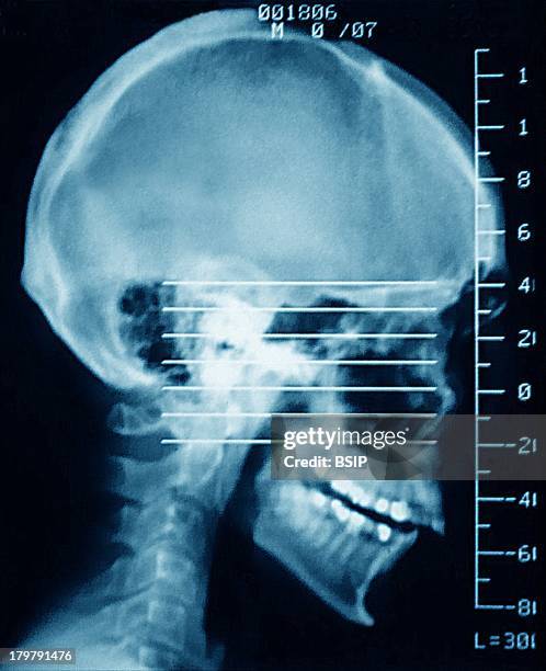 Scan of nasal cavities, axial slices