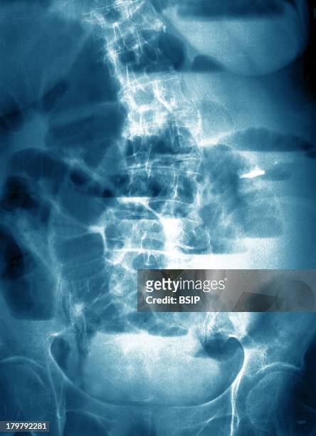 Impaction Of The Bowel, X-Ray.