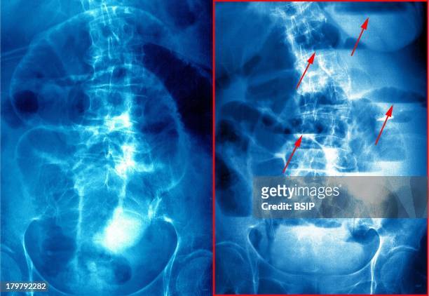 Impaction Of The Bowel, X-Ray.