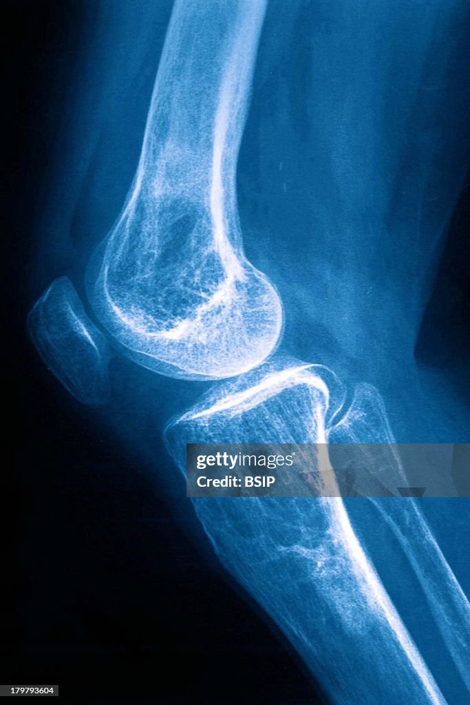 Osteoporosis X Ray Diminishing Bone Density In The Knee Sagittal osteoporosis-x-ray-diminishing-bone-density-in-the-knee-sagittal