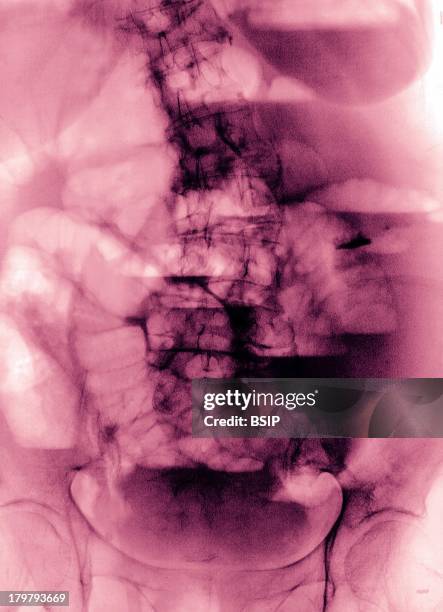 Impaction Of The Bowel, X-Ray.