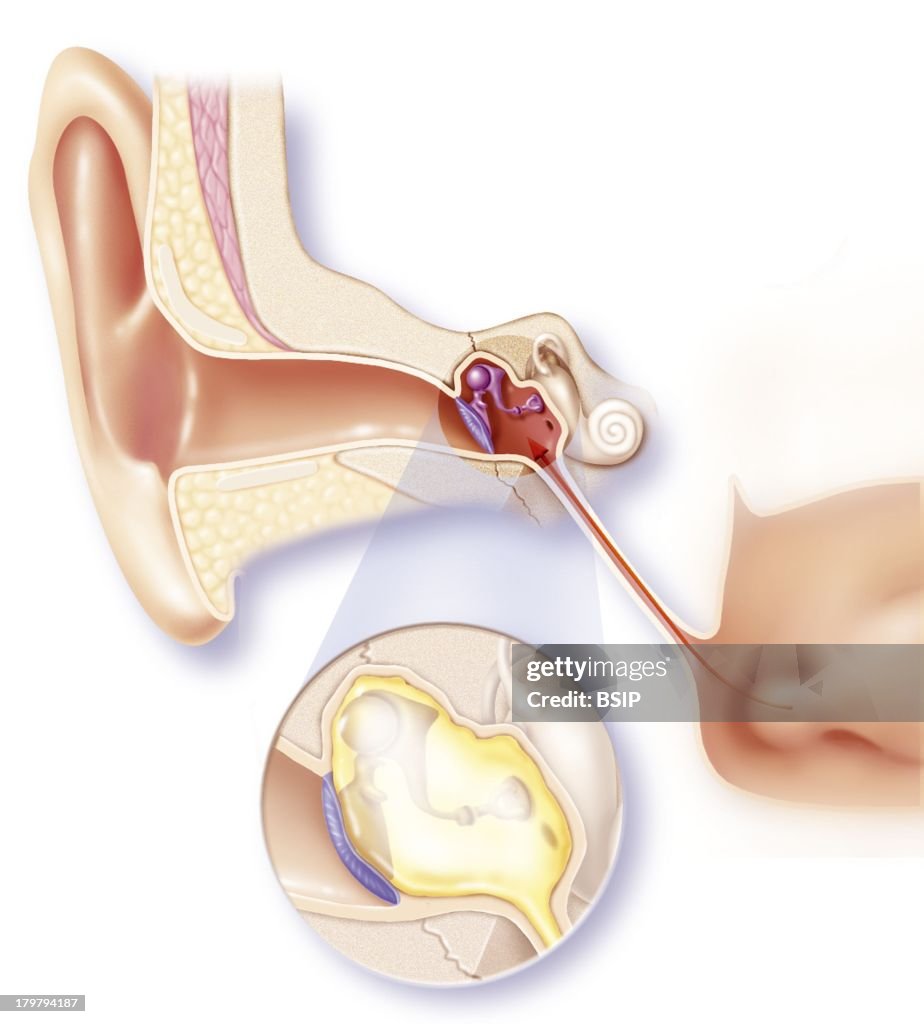 Acute Otitis, Illustration