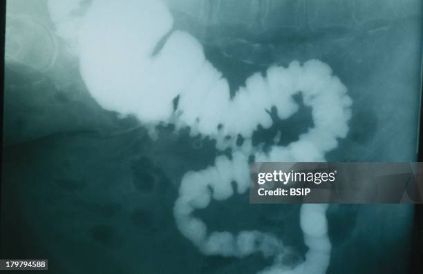 Barium Enema, Diverticular Sigmoiditis.