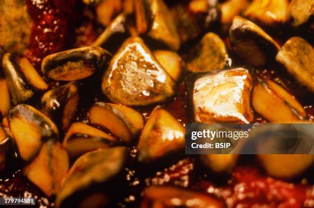 Gallstones, Pebble-like deposits that form inside the gallbladder.