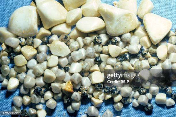 Gallstones, Pebble-like deposits that form inside the gallbladder.